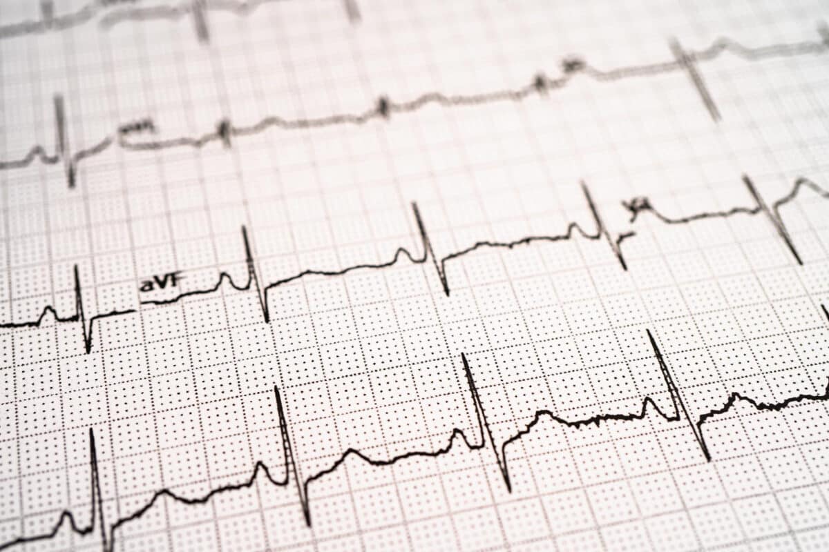 Précaution Précieuse : L'ECG comme garde-fou avant l'instauration du traitement du TDAH